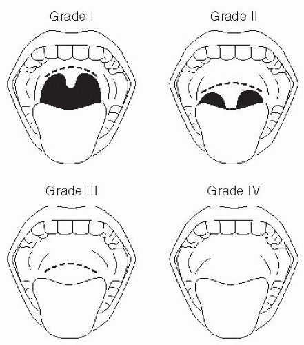 Endotracheal Intubation | Anesthesia Key