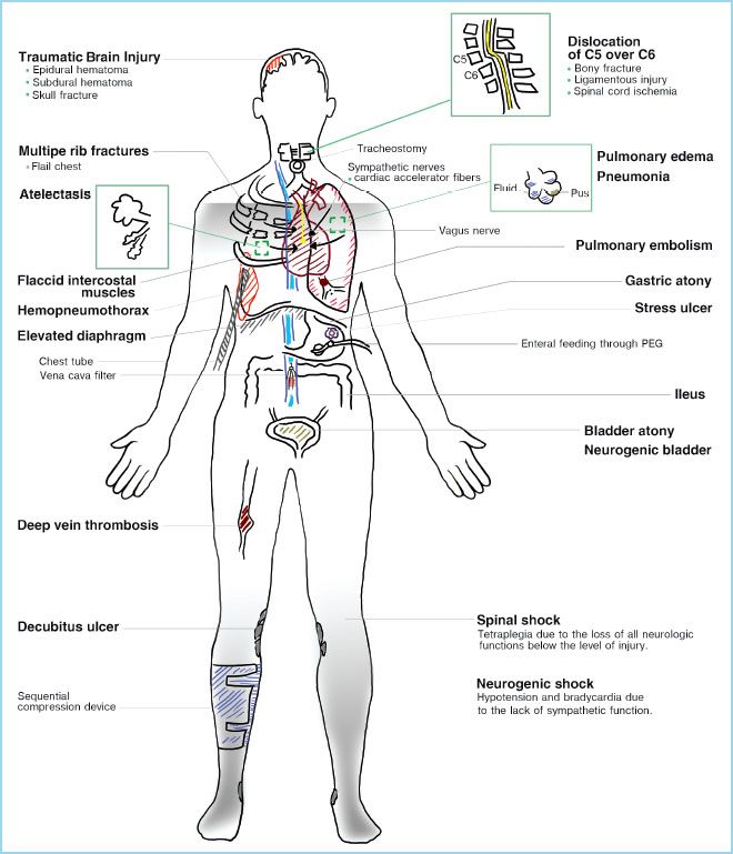 Intensive Care of Spinal Cord Injury in Adults | Anesthesia Key