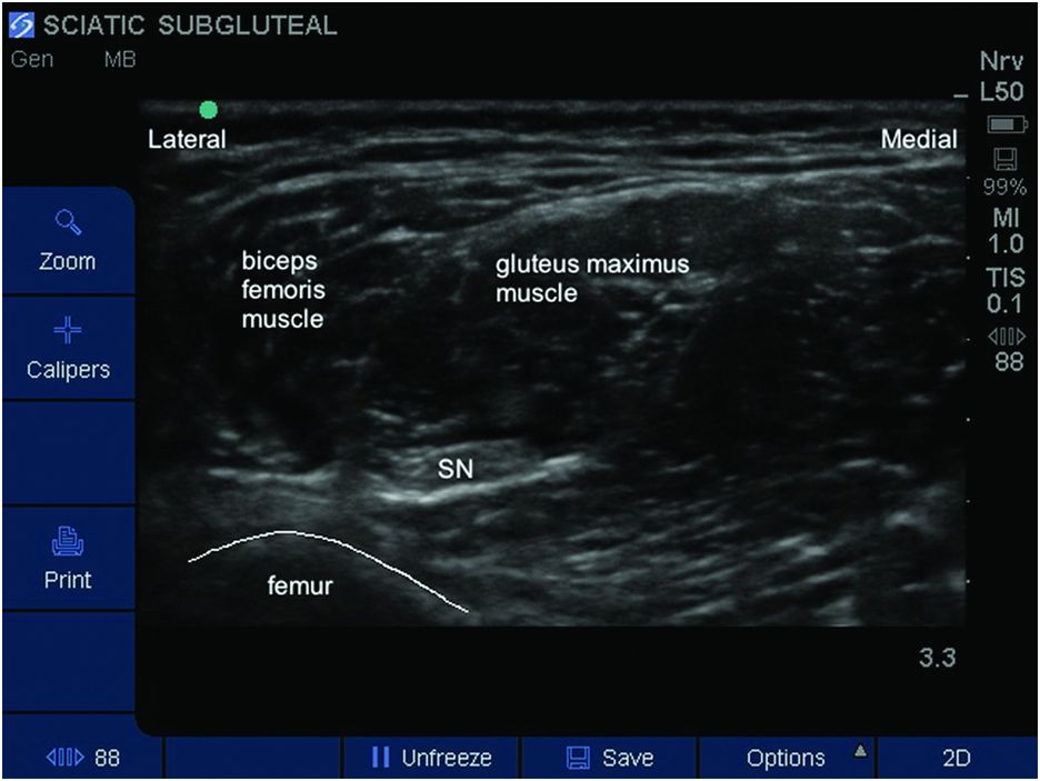 Proximal Sciatic Nerve Block Ultrasound Guided Anesth 2269