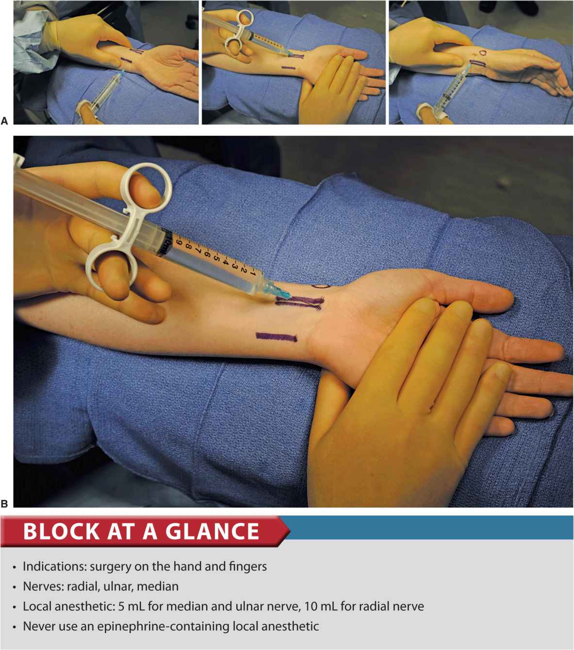 Wrist Block Anesthesia Key