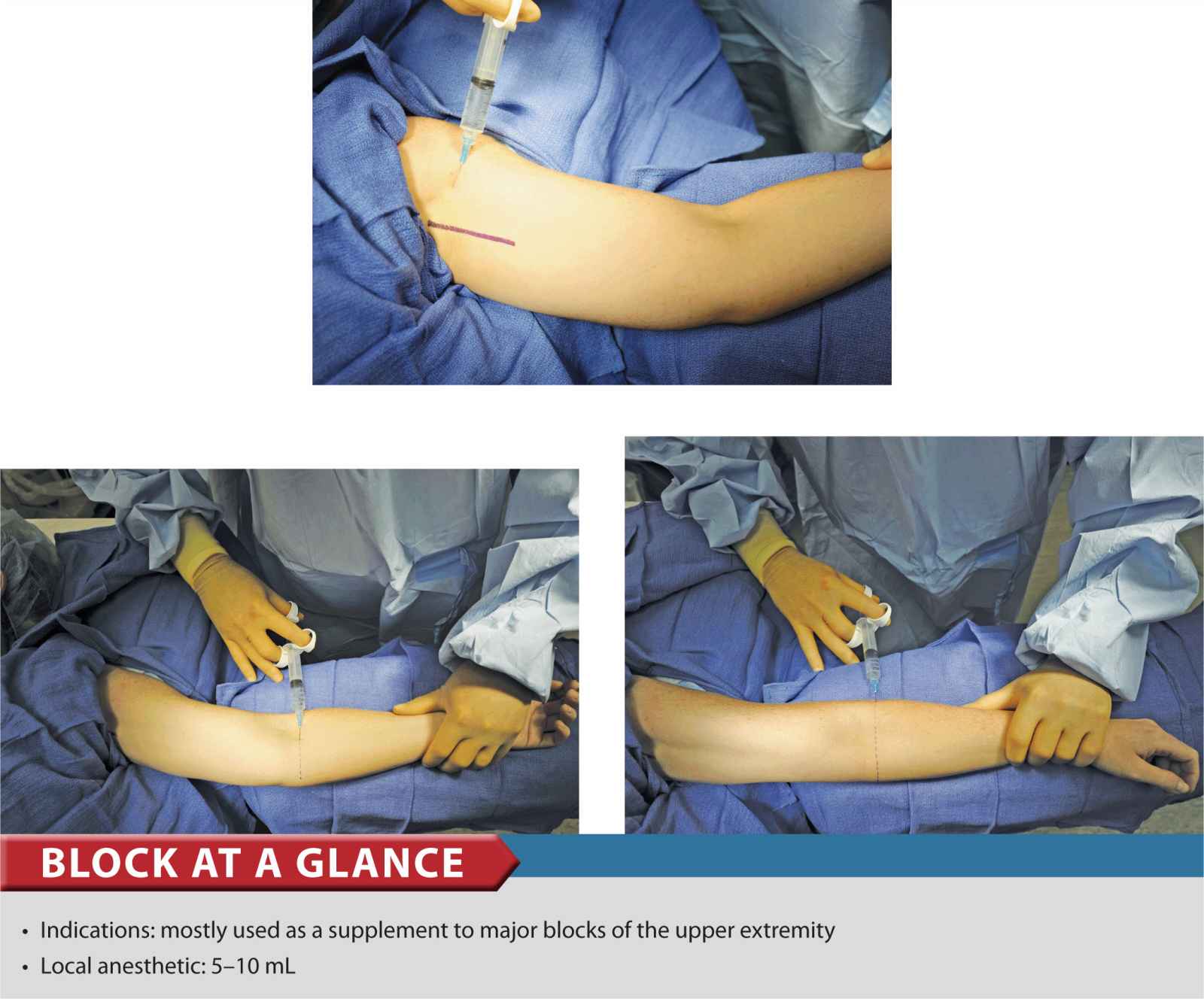 Cutaneous Nerve Blocks Of The Upper Extremity Anesthesia Key