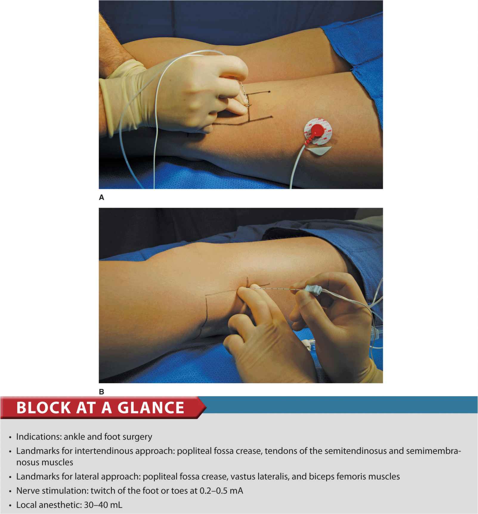 popliteal nerve block distribution