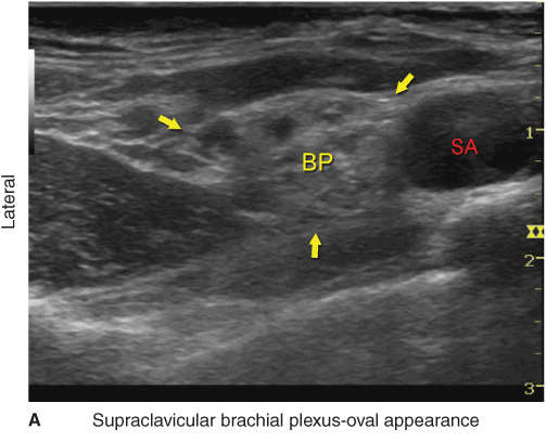 A Ultrasound Anatomy Of The Supraclavicular Brachial Plexus B Images