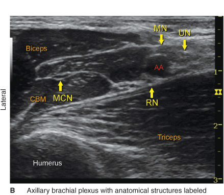 Ultrasound-Guided Axillary Brachial Plexus Block | Anesthesia Key