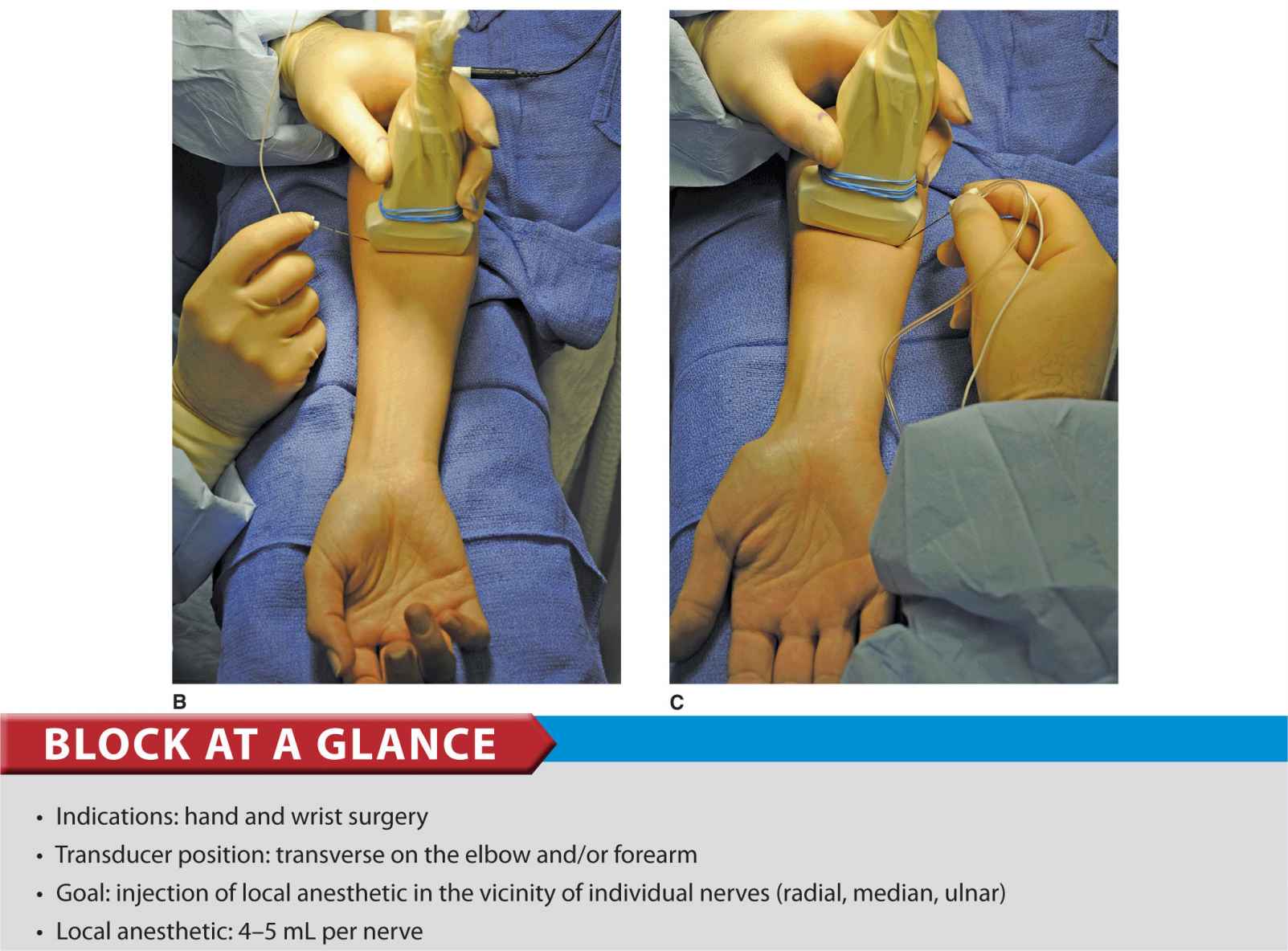 Ultrasound-Guided Forearm Blocks | Anesthesia Key