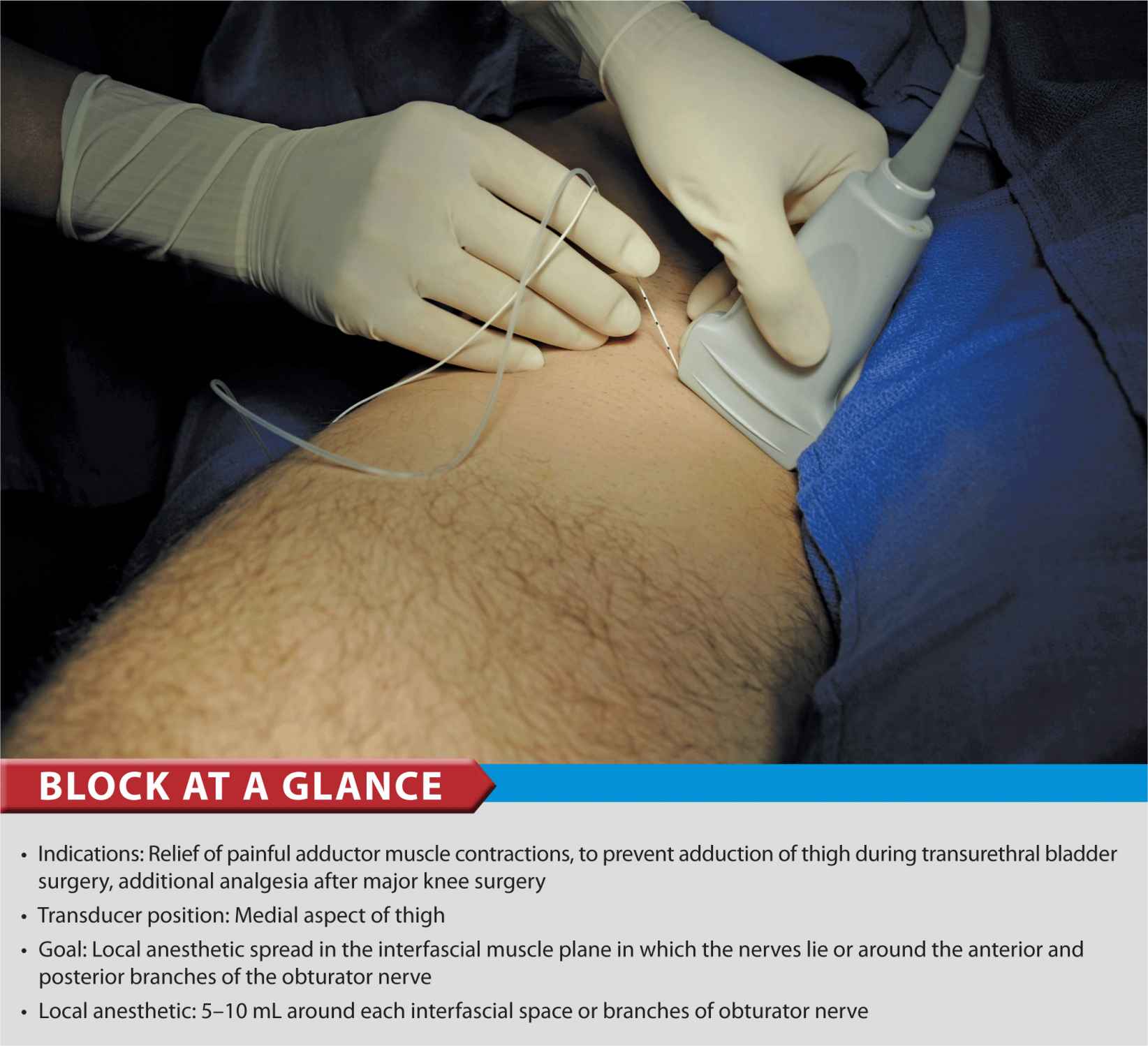 UltrasoundGuided Obturator Nerve Block Anesthesia Key