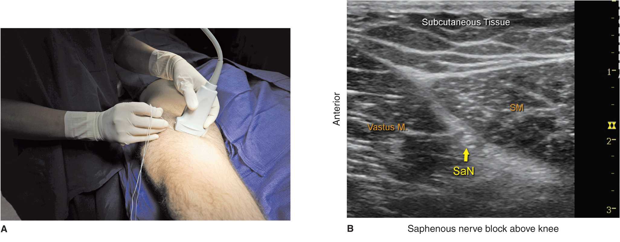 Ultrasound Guided Saphenous Nerve Block Anesthesia Key