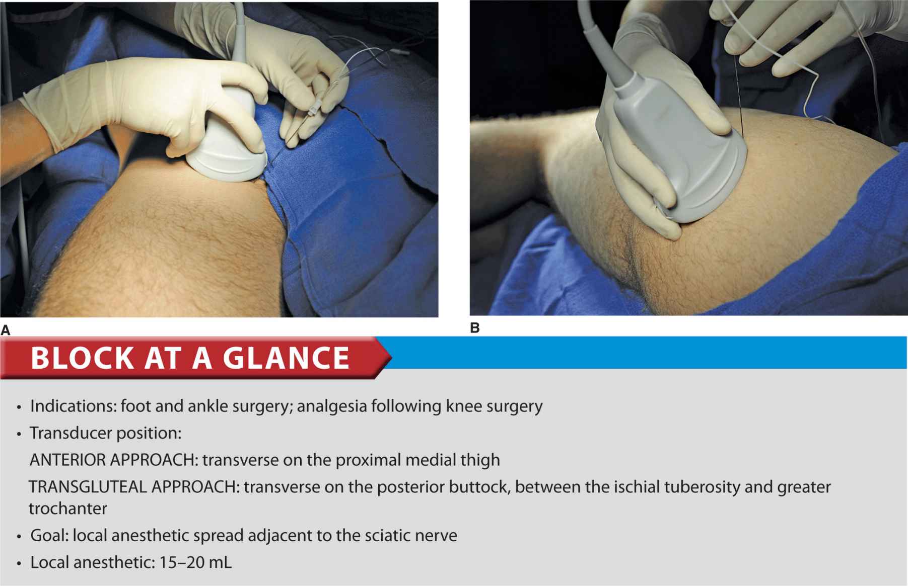sciatic nerve block anterior approach
