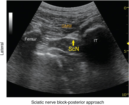 sciatic nerve block anterior approach