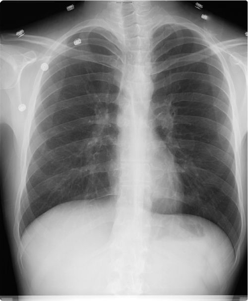 Diaphragmatic Injury | Anesthesia Key