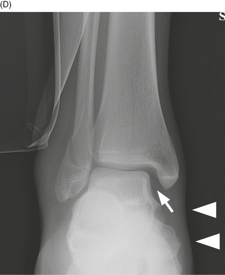 avulsion fracture ankle malleolus