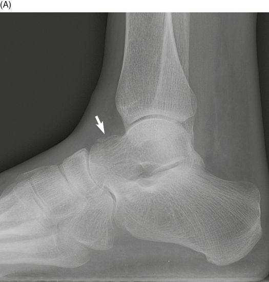 Fractures and dislocations of the tarsal bones | Anesthesia Key