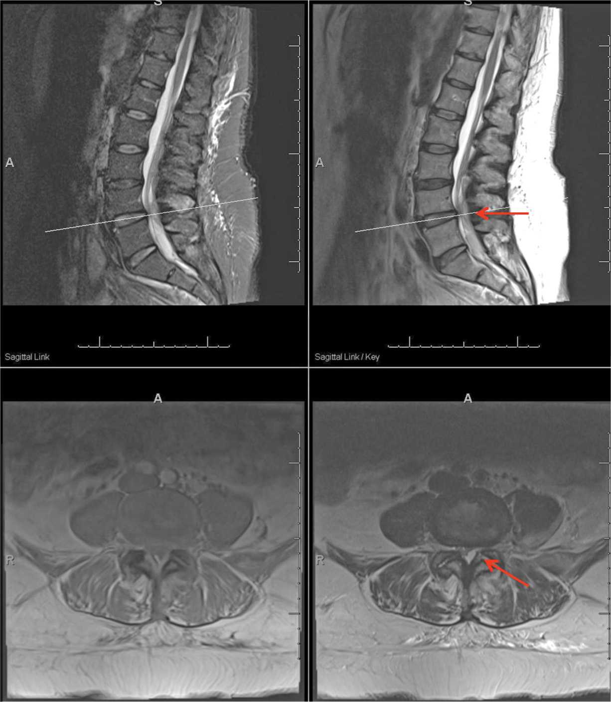 Lumbar Facet Joint Cyst Drainage and Injection Anesthesia Key