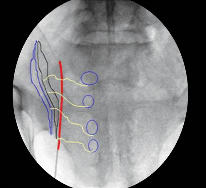 Start with a straight AP view of the sacrum centering on the ipsilateral SI...