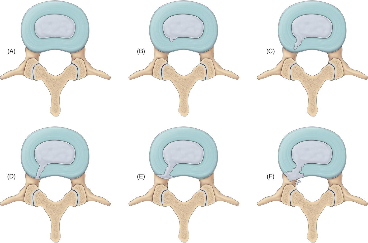 Парамедианная грыжа позвоночника. Discectomy Surgical Complications Part 1 of 2 | PROMEDSPINE. Crown Shape annulus.