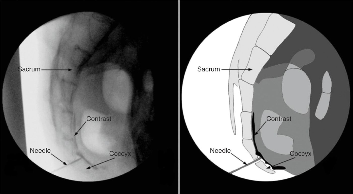 Ganglion Impar Block | Anesthesia Key