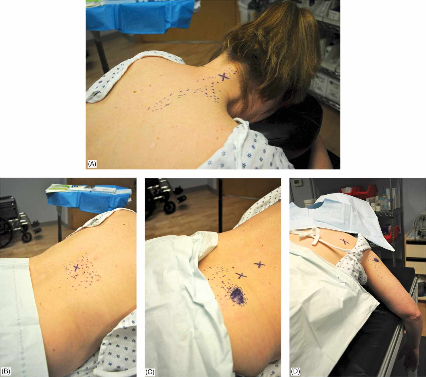 Finding Trigger Points - Latissimus Dorsi