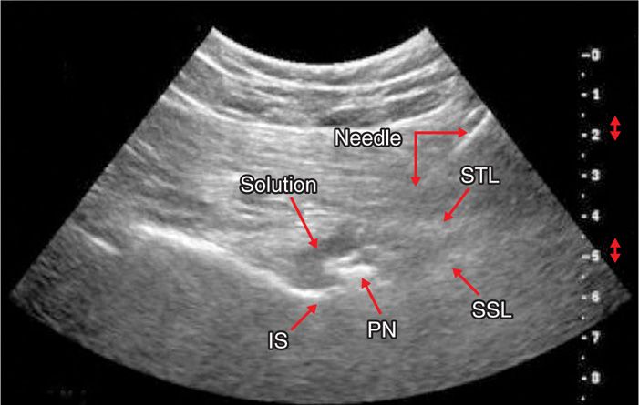 USN Open Archive: Intrapartum pudendal nerve block analgesia and