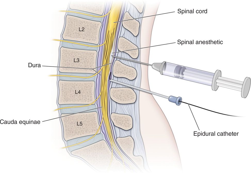 Intrathecal Drug Delivery Trialing Procedures Anesthesia Key