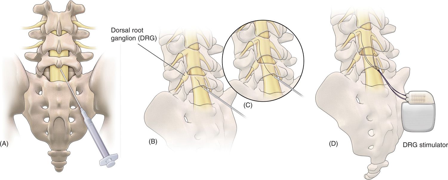 tens placement for dorsal column stimulation