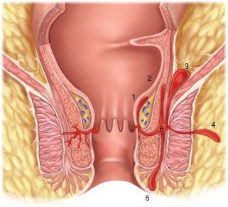 perirectal abscess