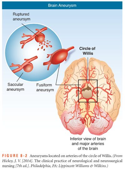 Subarachnoid Hemorrhage (SAH) - Willis-Knighton Health System