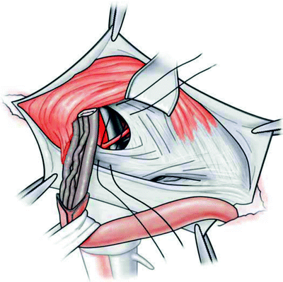 Repair of Inguinal and Femoral Hernias