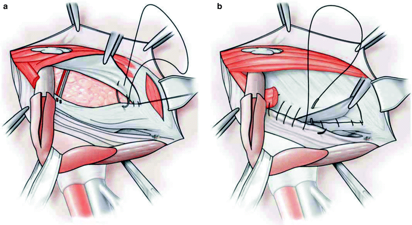 Repair of Inguinal and Femoral Hernias