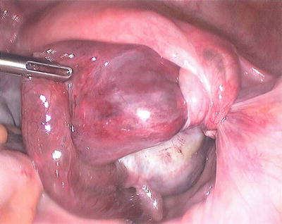 Laparoscopic resection of a torted ovarian dermoid cyst