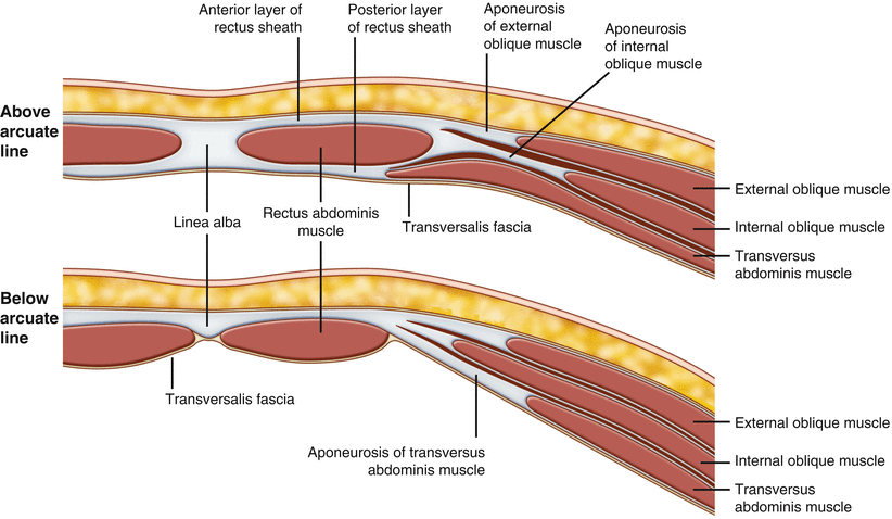 transversalis fascia hernia