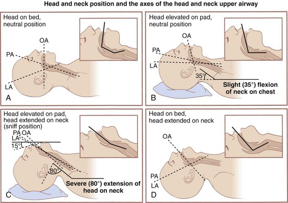 Laryngoscopic Orotracheal And Nasotracheal Intubation Anesthesia Key