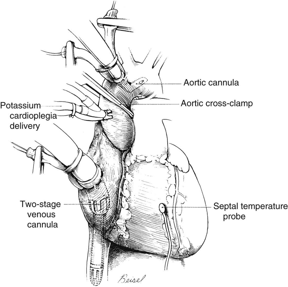 Care of the Cardiac Surgical Patient | Anesthesia Key