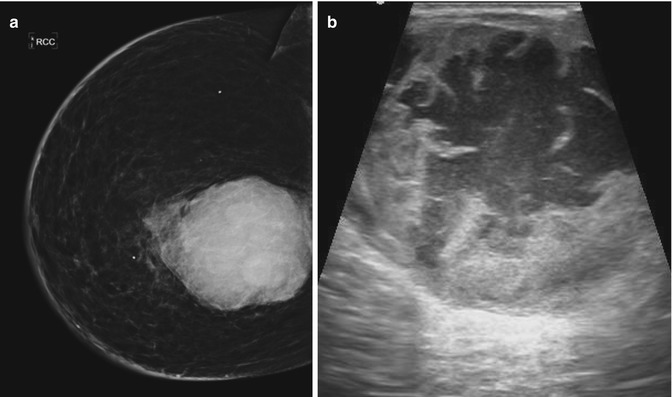 Fibrocystic Change: Involutionary Changes–Breast Cysts | Anesthesia Key