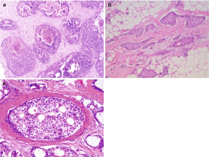 ductal-carcinoma-in-situ-anesthesia-key