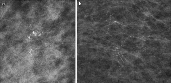 Ductal Carcinoma In Situ Anesthesia Key