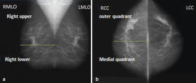 Step By Step Approach To Read A Mammogram Anesthesia Key