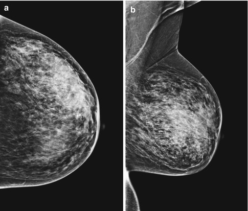 A mammogram of female breast, revealing micro-calcifications (white