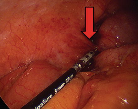 One-Trocar Trans-Umbilical Laparoscopic Hernia repair with Intraperitoneal  knot in Children