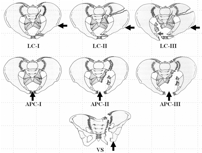 The morphological mapping of lateral compression type 1 pelvic fracture and pelvic  ring stability classification: a finite element analysis | Journal of  Orthopaedic Surgery and Research | Full Text