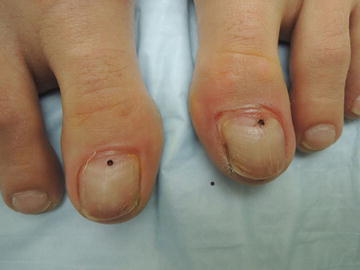 Bruise Under Toenail Pictures - Nail Ftempo