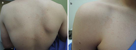 tinea versicolor before and after