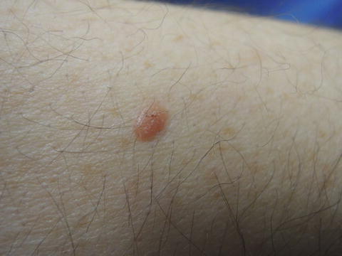 inflamed seborrheic keratosis