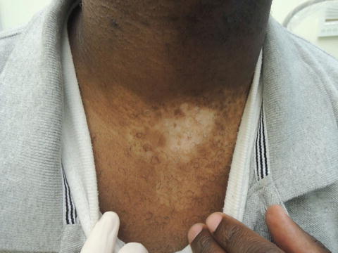 Penis vitiligo Vitiligo on