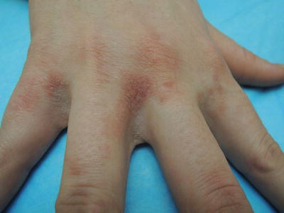 Scabies Bites On Hands