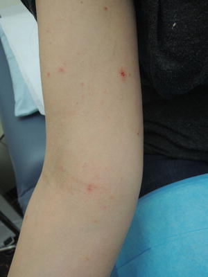 scabies burrows on legs