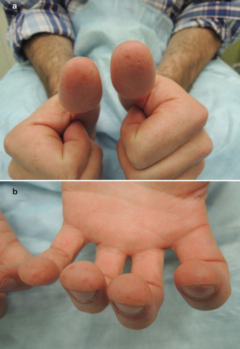 Hand Foot And Mouth Disease Anesthesia Key