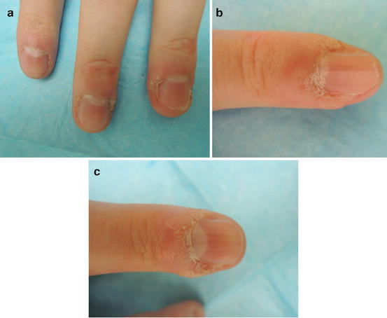 periungual erythema