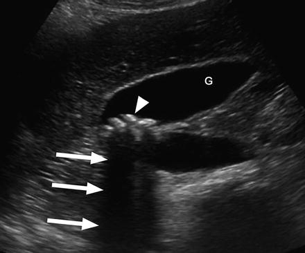 Management of Asymptomatic Gallstones | Anesthesia Key