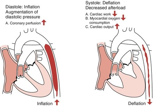 Iabp Cardiac Cycle