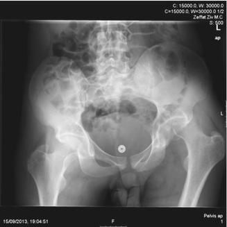 Neglected Fracture Of The Femoral Head With Hip Dislocation Anesthesia Key